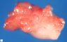 Vesical embryonal rhabdomyosarcoma