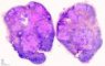 Mycobacterial adenitis.