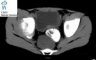 Pelvic intermixed ganglioneuroblastoma (Case 11543)