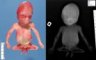 Caudal regression syndrome with lumbosacral agenesis and situs (...)