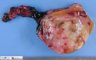 Clear cell sarcoma of the kidney (post-chemotherapy)