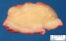 Intermixed ganglioneuroblastoma