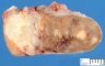 Multiple testicular adenomas in androgen insentivity syndrome