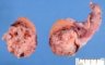 Testicular mixed germ cell tumor