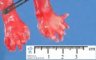 Hand post-axial polydactyly