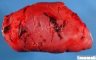 Splenic rupture in Burkitt lymphoma