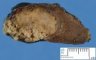 Thyroid papillary carcinoma