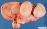 Uterine leiomyoma under the mucosa - tumor cut