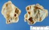 Bilateral hydronephrosis and bilateral megaureteres with posterior (...)