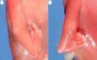 Radial aplasia in bilateral radial ray aplasia