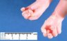 Camptodactyly in a Pena-Shokeir syndrome