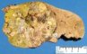 Hepatoblastoma
