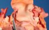 Dissection of proximal ascending thoracic aorta in Marfan disease