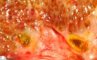 Dilatation of large bile ducts in extrahepatic biliary tract (...)