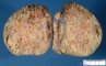 Pulmonary giant cystic chondroid hamartoma