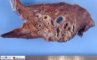 Pulmonary arteriovenous malformation in Hereditary hemorrhagic (...)