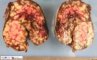 Torsion of an ovary with juvenile granulosa tumor