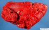 Splenic rupture in Burkitt lymphoma