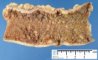 Crohn colitis