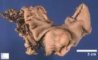 Gastric GIST