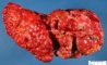 Macronodular cirrhosis and hepatocellualr carcinoma in tyrosinemia