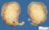 Cervical uterine leiomyoma