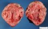 cystic partially differentiated nephroblastoma