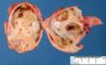 Ovarian endometriotic cyst