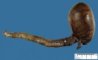 Cecal colonic atresia