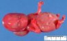 Left limb hypoplasia in a 18 weeks fetus