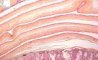 Membranes in diamniotic monochorionic twin pregnancy