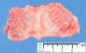 Multiple costal fractures in osteogenesis imperfecta type 2 (21 (...)