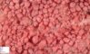 Multiple colonic adenomas in familial adenomatous polyposis