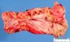 Colonic stenosis in Crohn disease