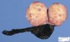 Testicular endodermal sinus tumor (Yolk sac tumor)