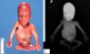 Caudal regression syndrome with lumbosacral agenesis