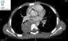 mediastinal ganglioneuroblastoma