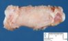 Enchondroma in Maffucci syndrome