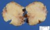 Lipoblastoma