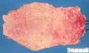 Rectal dilatation above a congenital anal stenosis